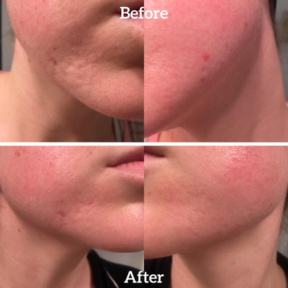 FEROUX™ Silicone Scar Sheets